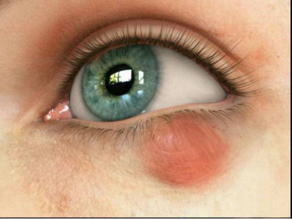 Халязион на глазу, как лечить? - Clean View Clinic