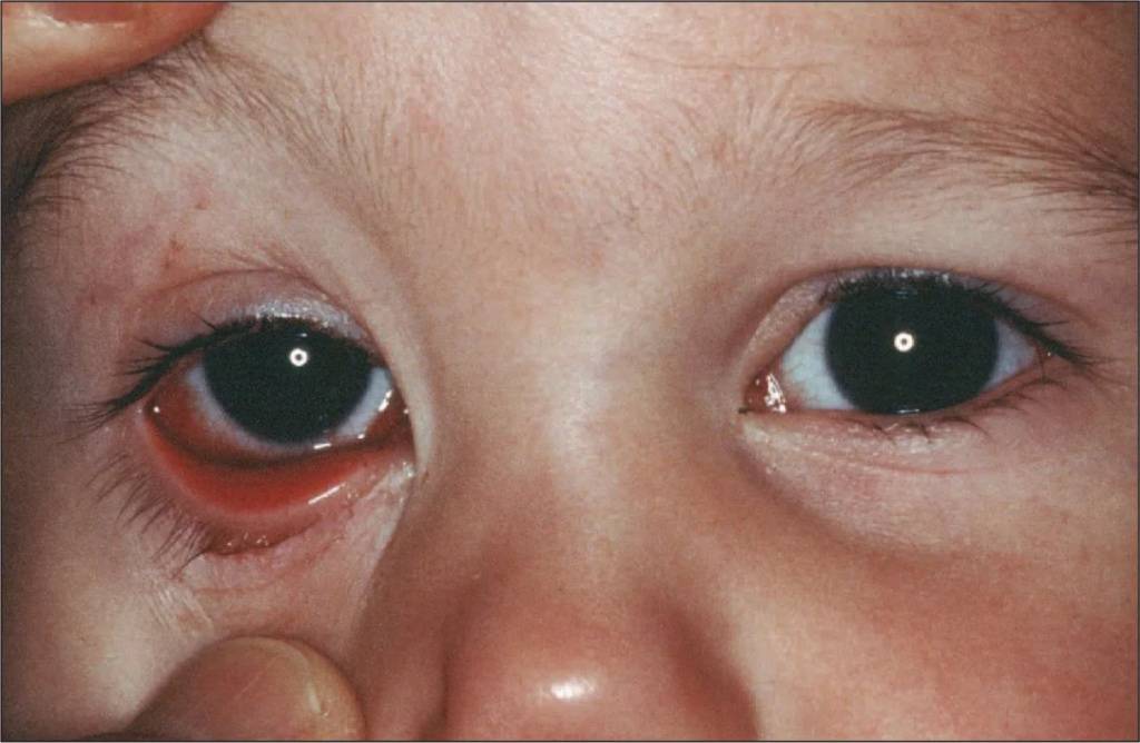 У ребёнка красные глаза: причины, лечение и профилактика
