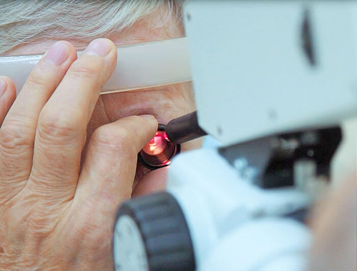 Лазерная дисцизия вторичной катаракты 