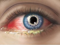 Воспалительные заболевания глаза