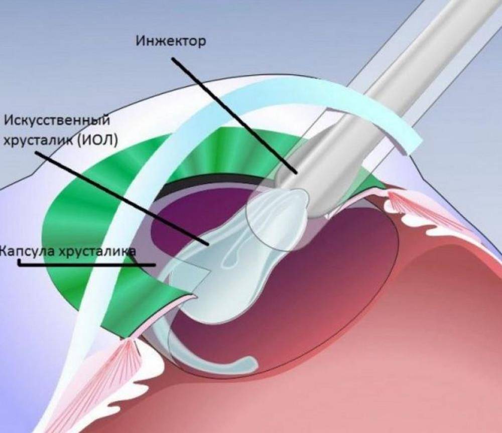 Что делать после операции по удалению катаракты?