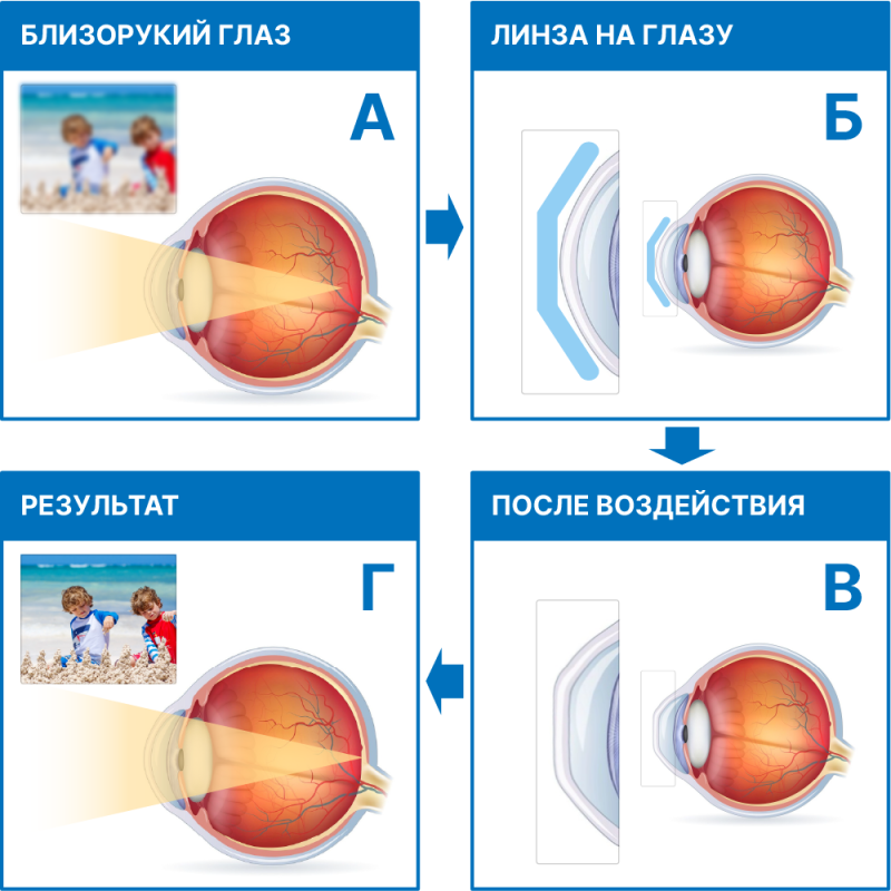 Схема_ночные линзы квадратная.png