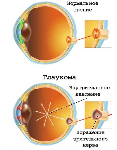Как возникает глаукома