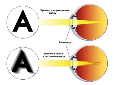 Смешанный астигматизм и его коррекция у детей и взрослых