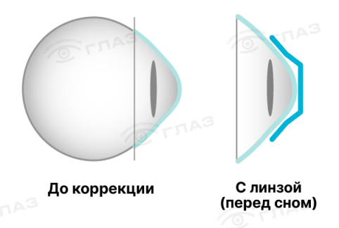 Картинка_Ночные линзы WM_2.png