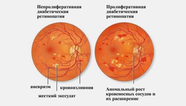 Диабетическая ретинопатияg