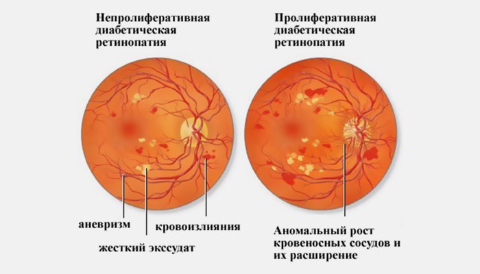 Диабетическая ретинопатия2.jpg