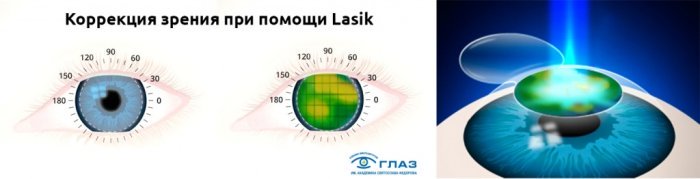 Лазерная коррекция Лэйзик (LASIK)