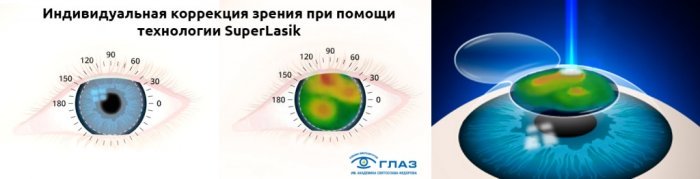 Лазерная коррекция зрения SuperLASIK