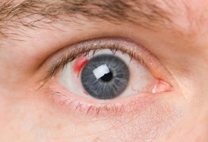 Ретинопатия сетчатки глаза