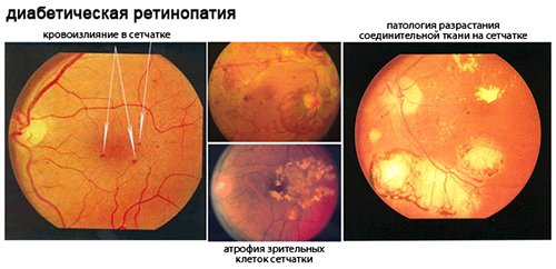 Диабетическая ретинопатия1