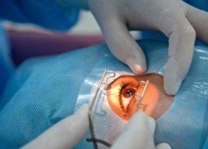 лечение катаракты-глаукомы
