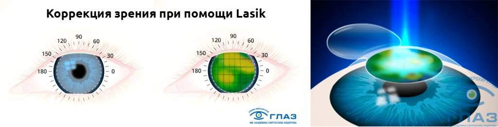 лазерная коррекция глаз lasik