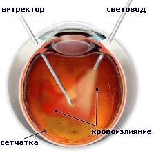 Лечение отслойки сетчатки глаза | Центр Лечения Катаракты