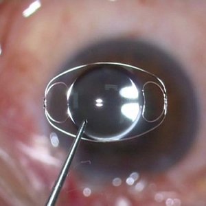 Искусственные хрусталики - какие бывают?