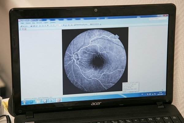 Оптическая когерентная томография (ОКТ) глаза