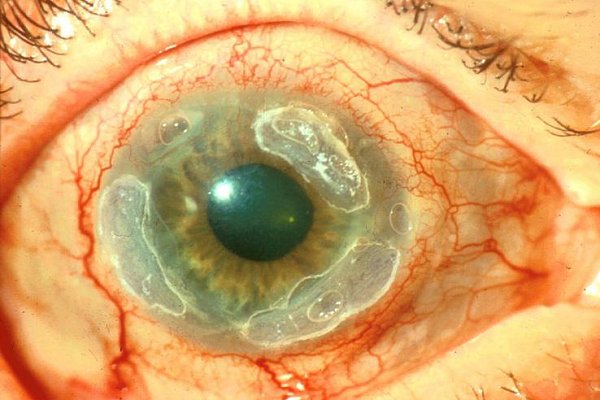 Лечение кератита