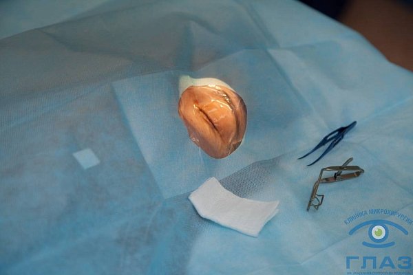 Лечение катаракты в Тюмени