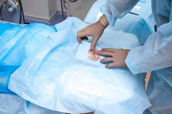 Рефракционная замена хрусталика при высокой дальнозоркости в клинике микрохирургии «ГЛАЗ» имени Святослава Федорова