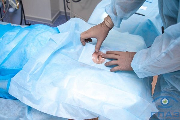 Лечение катаракты в Сургуте